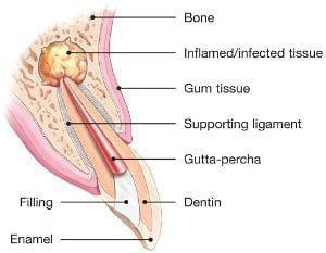 Endodontic Surgery